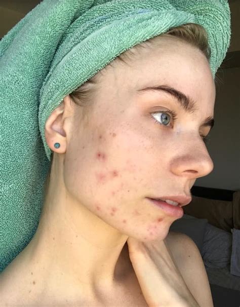 Blogger 28 Who Suffered Painful Cystic Acne Reveals The Five Step