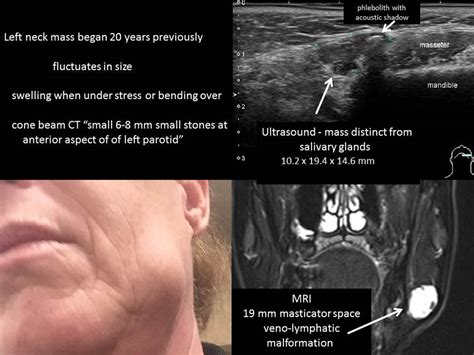 Ultrasound Appearance Of Facial Venolymphatic Malformation With