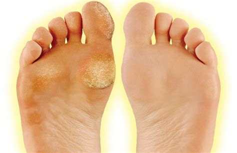 How To Get Rid Of Calluses On Feet Neybg