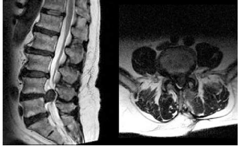 MRI Of Bulging Disc Lower Lumbar