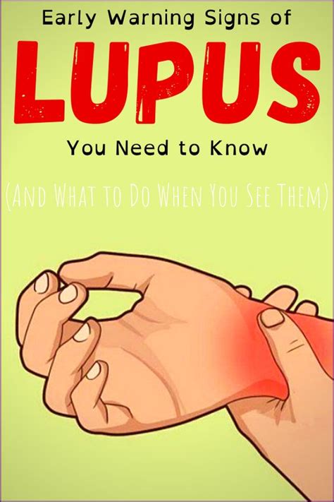 10 Early Signs Of Lupus