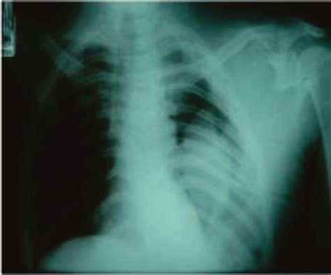 Chest Radiograph Fallen Lung Sign And Complex Scapular Fracture To