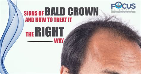 Signs Of Bald Crown And How To Treat It The Right Way