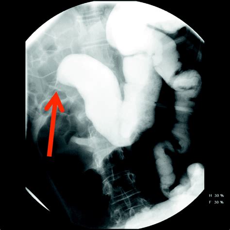 Pediatric Colonic Volvulus A Single Institution Experience And Review