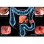 Colorectal Cancer  Notes On Cyber Gastroenterology Murrasacacom