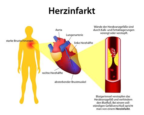 Kribbeln In Der Linken Hand Herzinfarkt Captions Hunter