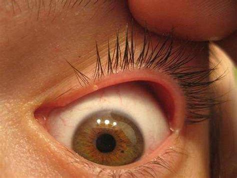 What Causes White Bump Inside Lower Eyelid