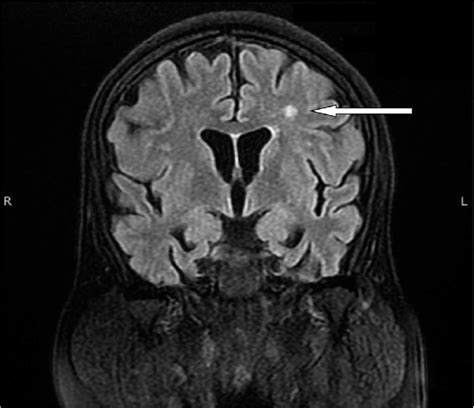 Magnetic Resonance Imaging Of Brain T2 Showing Abnormal Signal