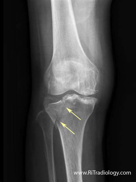 Rit Radiology Tibial Plateau Fracture