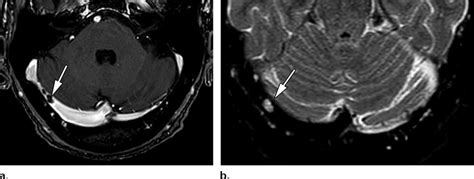 Normal Appearance Of Arachnoid Granulations A Axial Download