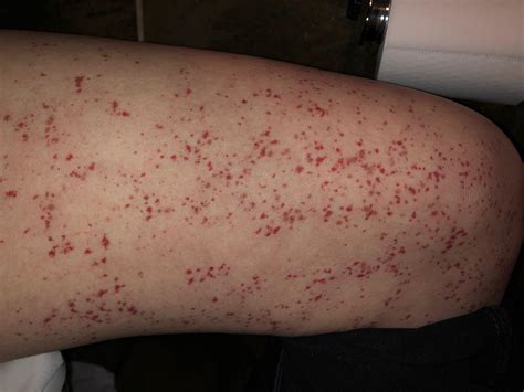 Blood Spots Under Skin Rdermatology