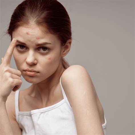 What Can You Do If Your Acne Is Getting Worse Skin Perfection