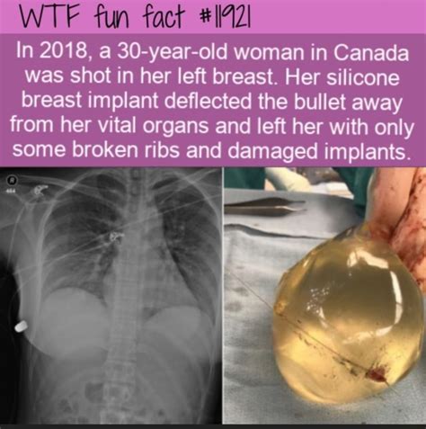 Wtf Fun Fact In 2018 A 30 Year Old Woman In Canada Was Shot In Her
