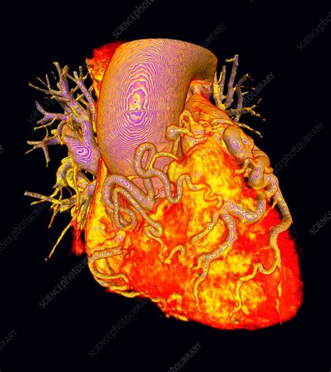 Heart With Dilated Coronary Arteries 3d Ct Scan Stock Image C036