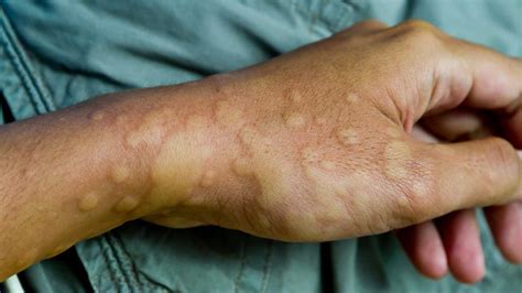What Are Chronic Hives Urticaria Causes And Treatment Goodrx