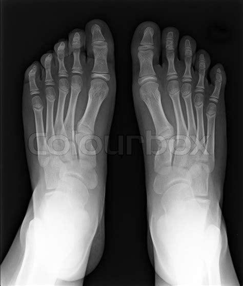 Mri Of Foot Fingers Exposed On X Ray Stock Image Colourbox