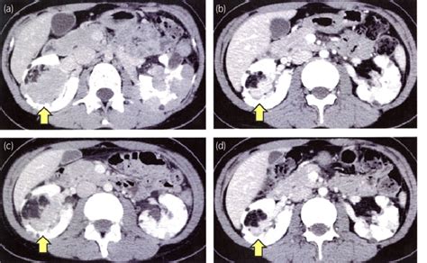 Axial Contrast Enhanced Ct Scan Of The Kidney A Before Treatment