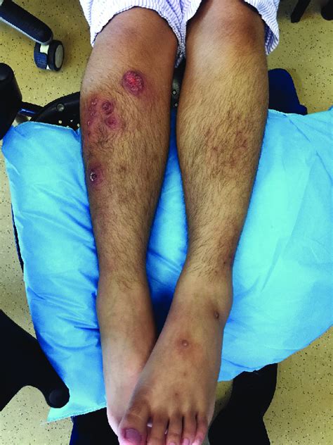 Clinical Photo Of Skin Lesions On Subsequent Presentation Presence Of