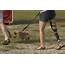 New Prosthetic Leg Helps Patients Regain Feeling Post Amputation And 