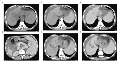 Ct Of The Abdomen Showing The Segment 3 Liver Lesions At Diagnosis A