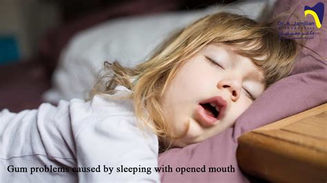 Gum Problems Caused By Sleeping With Opened Mouth Dr Jamilian