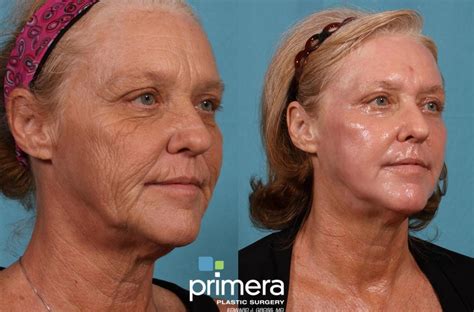 Before And After Photos Of Deep Chemical Peel 110