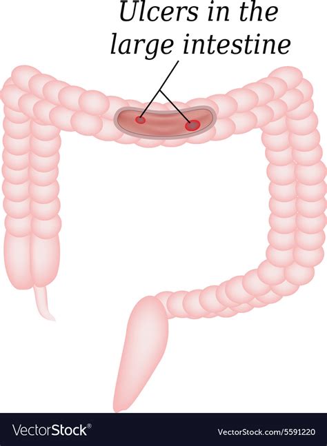 Ulcer In The Intestine Ulcers In The Colon Vector Image