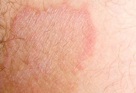 Explore pictures, causes, signs and symptoms, treatments and home remedies. Inner thigh rash- 15 Causes,Symptoms & Treatments