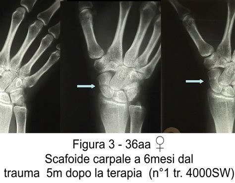 Pseudoartrosi di Scafoide - Prof. Rocco Papalia