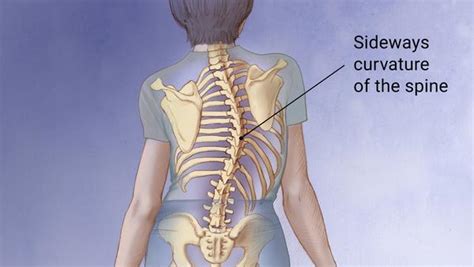 Scoliosis Relief Care Med Choice Llc