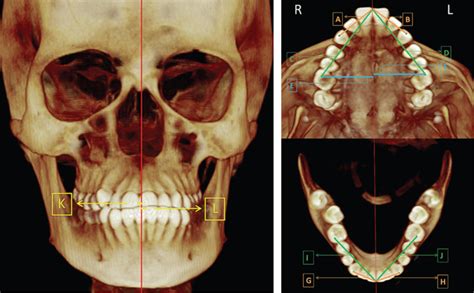 Evaluación De La Asimetría Dental Y Esqueletal Por Tomografía