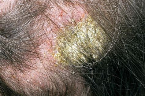 Infected Eczema On The Scalp Photograph By Dr P Marazziscience Photo