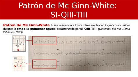 Cardiotruco Patrón De Mcginn White Cardioprimaria Ferrol