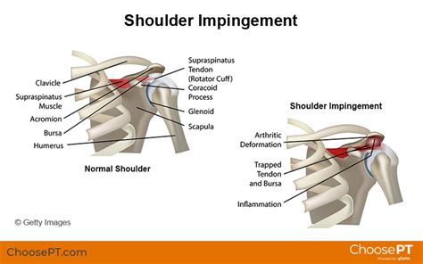 Guide Physical Therapy Guide To Shoulder Impingement Syndrome Choose Pt