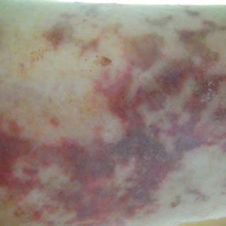 ( 5) changes in skin color, such as blue or pale skin. (PDF) Septic skin lesions: An uncommon manifestation of peripheral prosthetic vascular graft ...