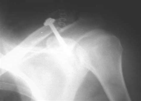 Figure 1 From Treatment Of Neer Type 2 Fractures Of The Distal Clavicle