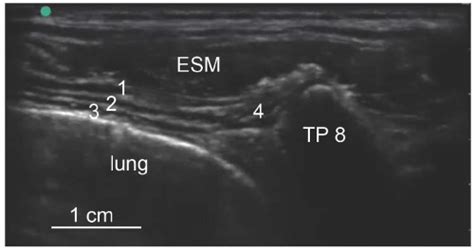 Ultrasound Guided Epidural Block Caudal Lumbar And Thoracic