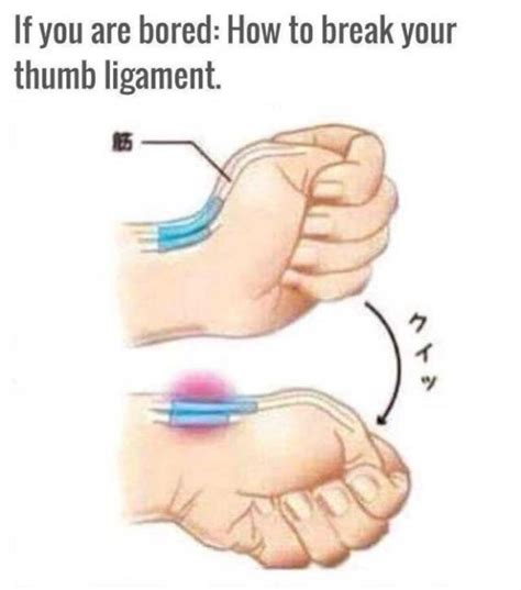 How to tell if you have a fractured wrist. How To Dislocate Your Thumb | Others