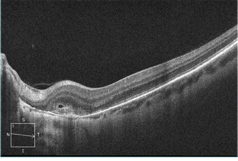 Pseudoxanthoma Elasticum Pxe With Cnv Retina Image Bank