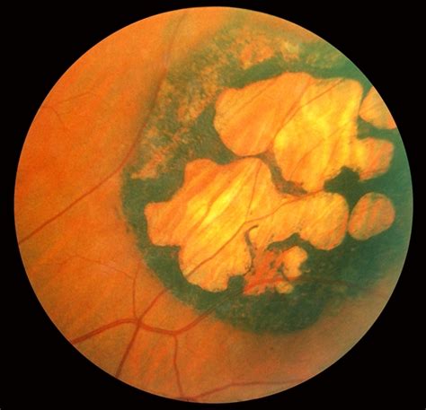 Congenital Hypertrophy Of Rpe Retina Image Bank