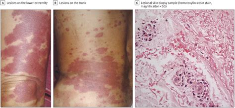 A Common Purpuric Rash With Uncommon Association In A Woman With Pedal