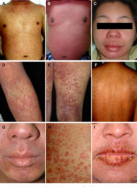 Figure 1 From Drug Reaction With Eosinophilia And Systemic Symptoms A