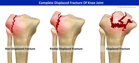 Knee Joint Fractureclassificationtypescausessymptomssigns
