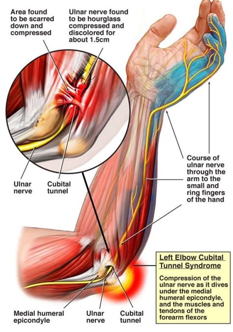 After helping people with the game a bit i decided to compile a list of solutions to most common problems. EMG Best Test To Diagnose Cubital Tunnel | Neuro Testing Group