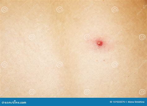 Close Up Of A Pimple On The Back Stock Image Image Of Disease