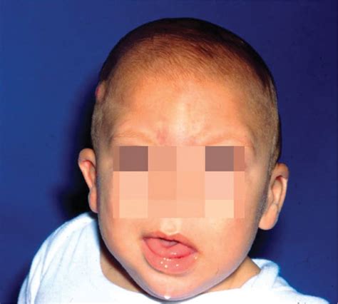 Abnormal Head Shape Visual Diagnosis And Treatment In Pediatrics 3 Ed