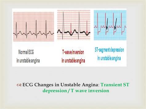 Unstable angina is a dangerous condition that threatens the development of myocardial infarction and related complications. Anaesthetic Management of a Patient with Ischaemic Heart ...