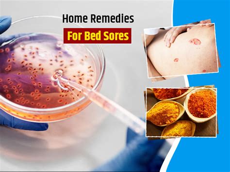Bed Sores Remedies Try These 6 Home Hacks For Relief Onlymyhealth