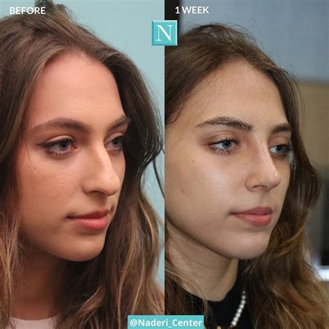 Nose Plastic Surgery Nose Surgery Chin Implant Nose Reshaping Nose