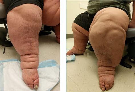Get insights on various causes, symptoms, treatment, is elephantiasis contagious? Lymphatic Disease Archives - Angiologist